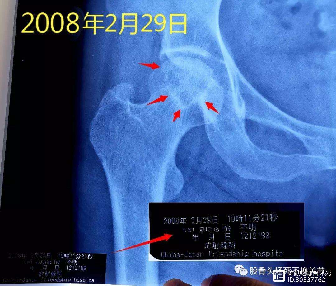 莆田人工骨头医保报销多少(人工骨头医保报销多少比例)